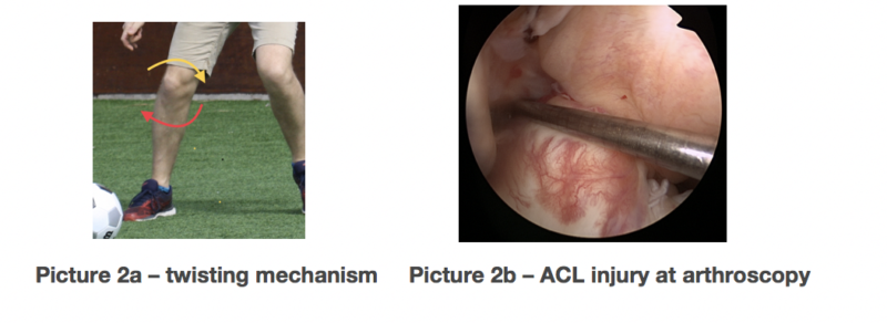 anteriorcruciateligament02