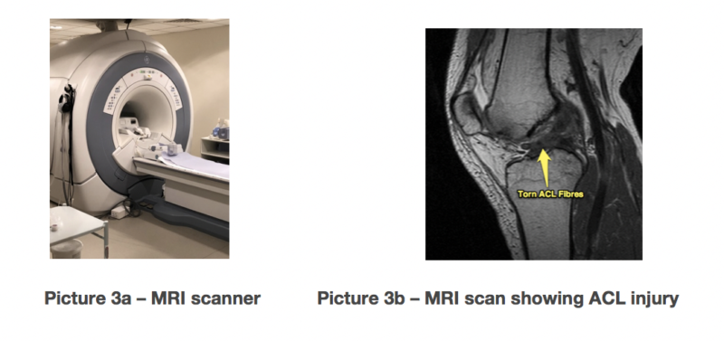 anteriorcruciateligament03