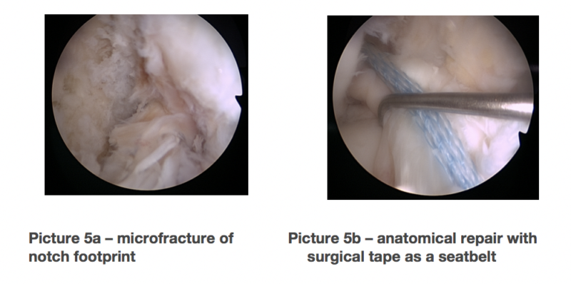 anteriorcruciateligament05