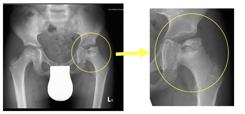 perthesdisease01